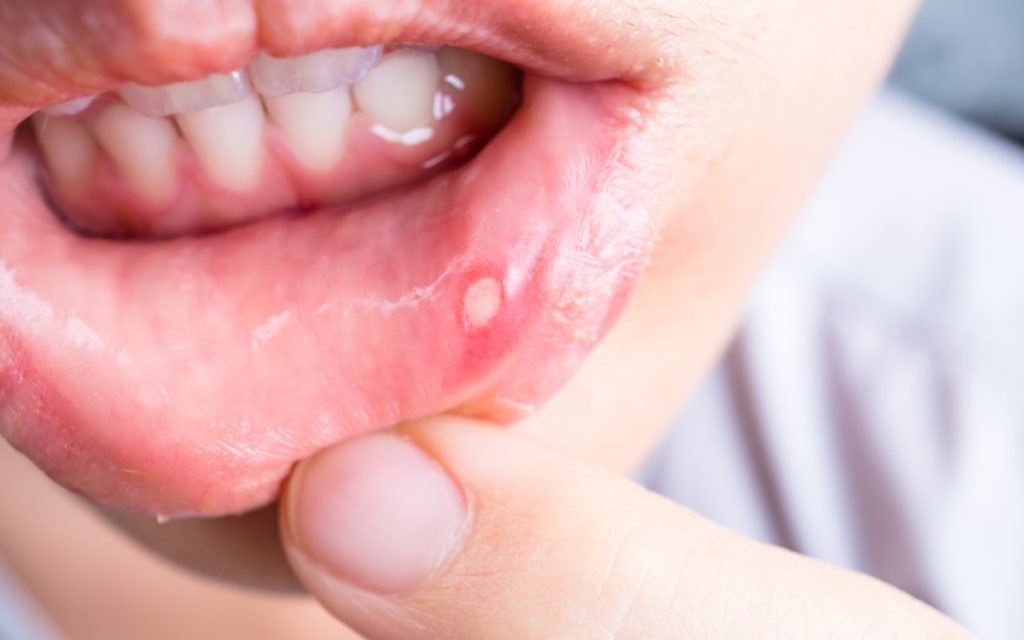 common-causes-of-mouth-soreness